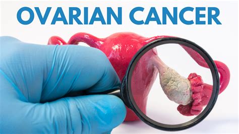 Ovarian cancer: