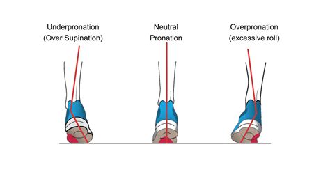 Overpronation vs Underpronation: A Comprehensive Guide to Foot Mechanics