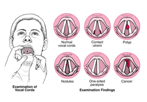 Overuse of the vocal cords: