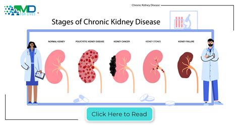 Overview of Stage 4 Renal Insufficiency