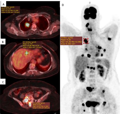 PET/CT in the Management of Lung Cancer Doc