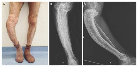 Paget's Disease of Bone Doc