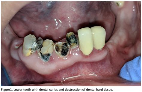 Pain Points: The Burden of Dental Neglect