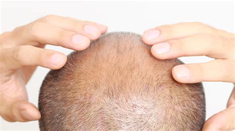 Pain Points of Hair Loss: