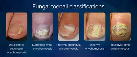 Pain Points of toenail fungus