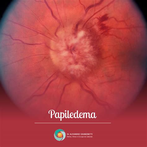 Papiledema: Causas, Sintomas e Tratamento