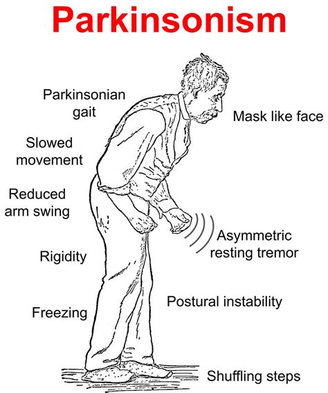 Parkinsonism and Related Disorders Reader