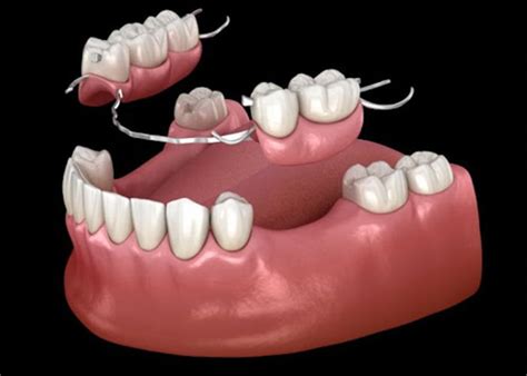 Partial Dentures Cost With Insurance: Uncover the $1,200 - $3,900 Price Tag