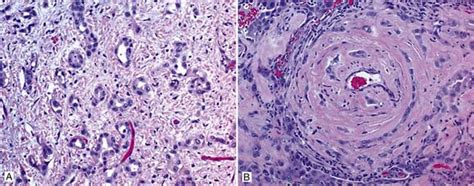 Pathology of Malignant Mesothelioma 1st Edition Kindle Editon