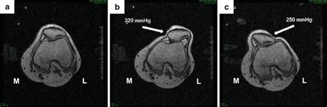 Patylopez: An In-Depth Exploration of the Patellofemoral Joint