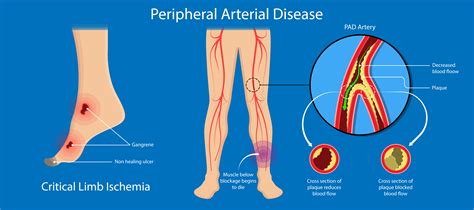 Peripheral Arterial Disease Epub