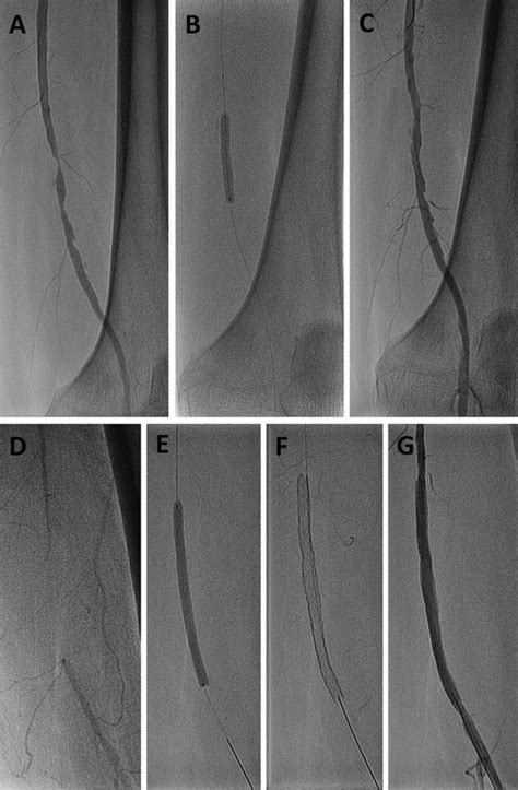 Peripheral Endovascular Interventions Kindle Editon