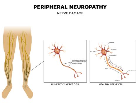 Peripheral neuropathy: