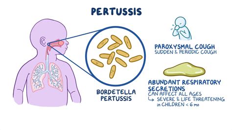 Pertussis