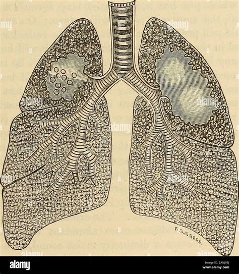 Phthisis Pulmonalis Kindle Editon