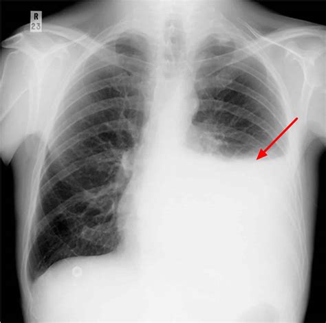 Pleural Effusion: