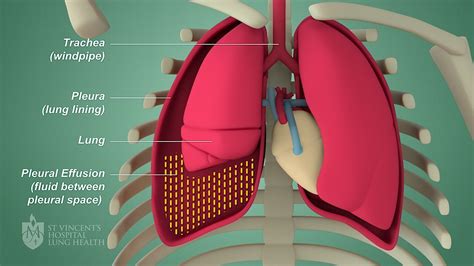 Pleural effusion: