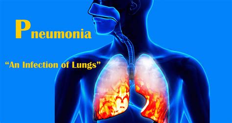 Pneumonia PDF