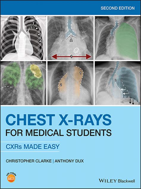 Pocket Guide to Chest X-rays 2nd Edition Kindle Editon