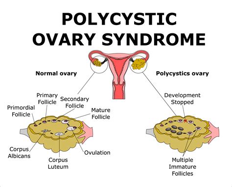 Polycystic Ovarian Disease PDF
