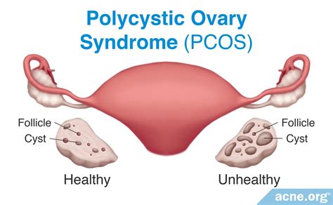 Polycystic Ovary Syndrome (PCOS):