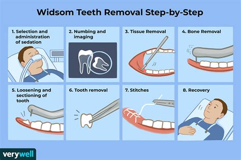 Post-Wisdom Teeth Removal Recovery: Can You Use Zyn?