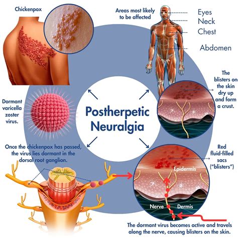 Postherpetic neuralgia: