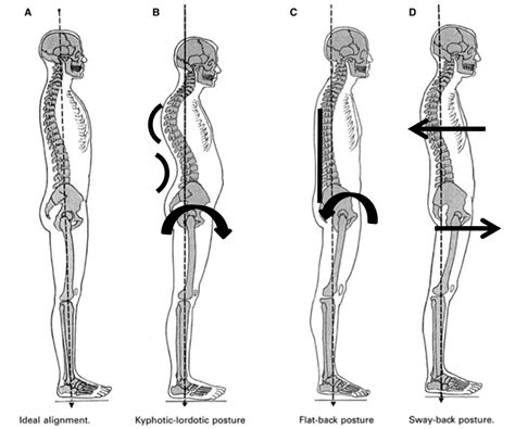 Posture Alignment: