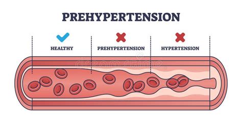 Prehypertension: