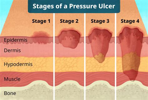 Pressure Ulcers Reader