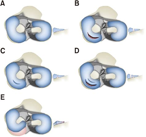 Prevalence and Causes of Meniscus Tears in Dogs: