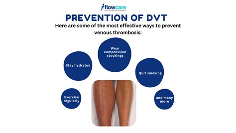 Prevention of DVT: