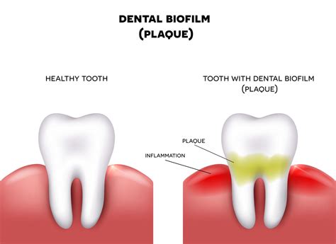 Prevents plaque accumulation: