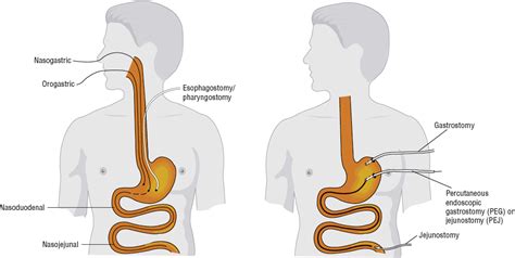 Prone K Tube: The Next Level Solution for Enteral Feeding