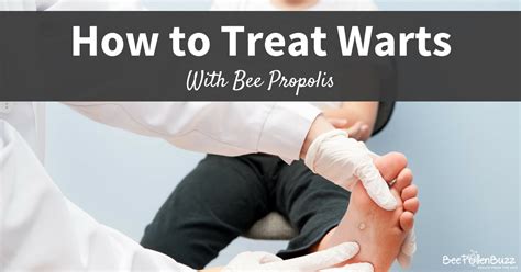 Propolis for Warts: Testimonials and Efficacy