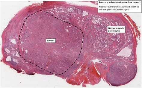 Prostate Pathology Epub