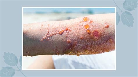 Protection from poison ivy rash: