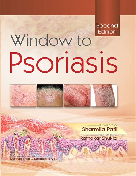 Psoriasis Ebook Doc