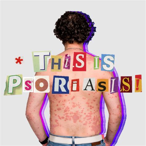 Psoriasis on Legs: 10,000+ Captivating Images to Aid Diagnosis and Treatment