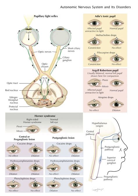 Pupillary Abnormalities: