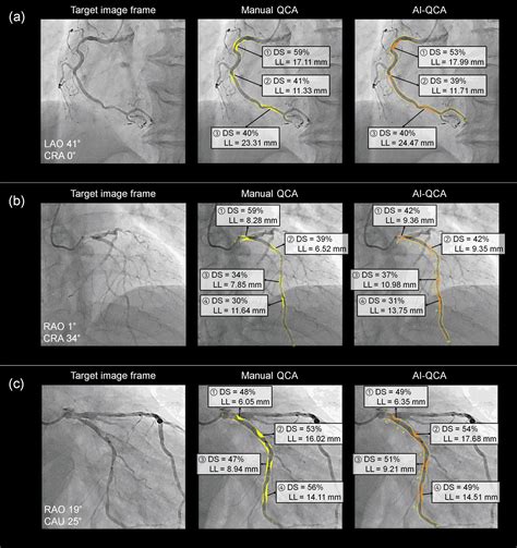 Quantitative Coronary Arteriography Reader