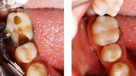 Quanto Custa uma Restauração de Dente da Frente: Guia Definitivo