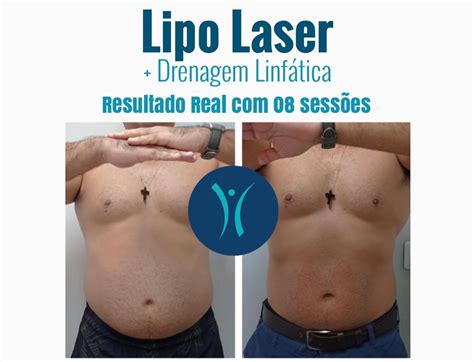 Quanto tempo a pele cola depois da lipo?