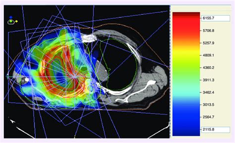 Radiation Therapy Planning Doc