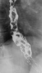 Radiologic Examination of the Orohypopharynx and Esophagus The Barium Swallow PDF