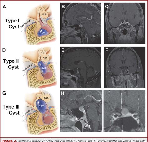 Rathkes Cleft Cyst Size Chart