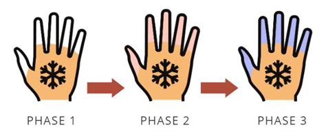 Ray Misty Ray: A Comprehensive Guide to Understanding and Managing Raynaud's Phenomenon