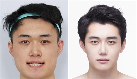 Reasons Why Asian Men Seek Surgery to Look White