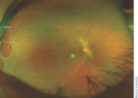 Recent Advances in Retinal Degeneration Reader