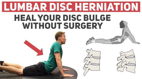 Reclaiming Your Spine: Spinal Disc Herniation Exercises for Relief and Recovery